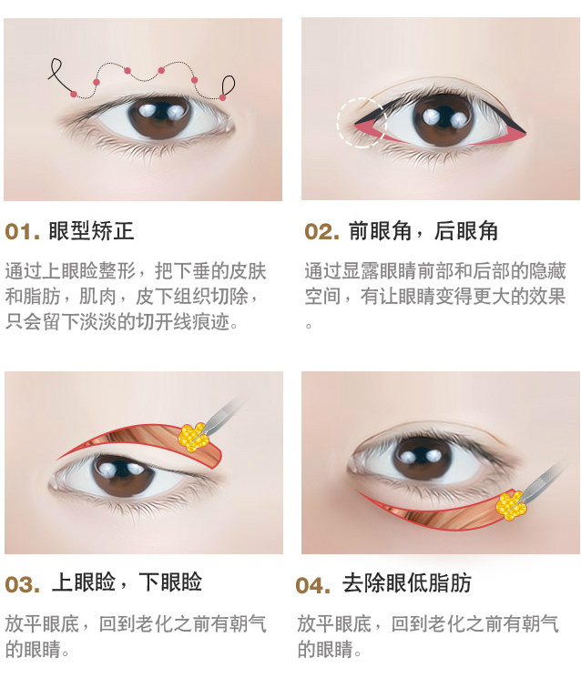 双眼皮