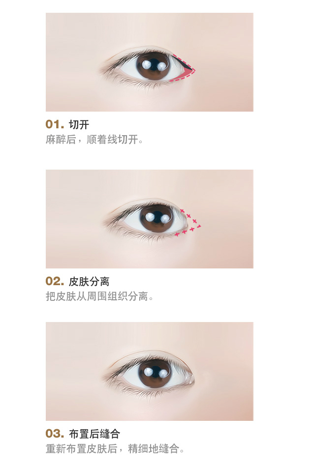 开眼角整形