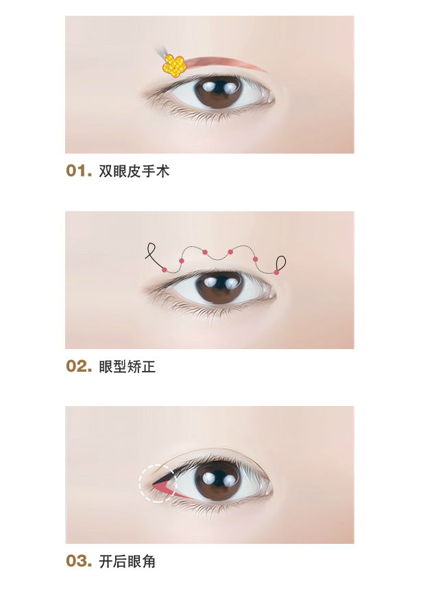 开眼角整形