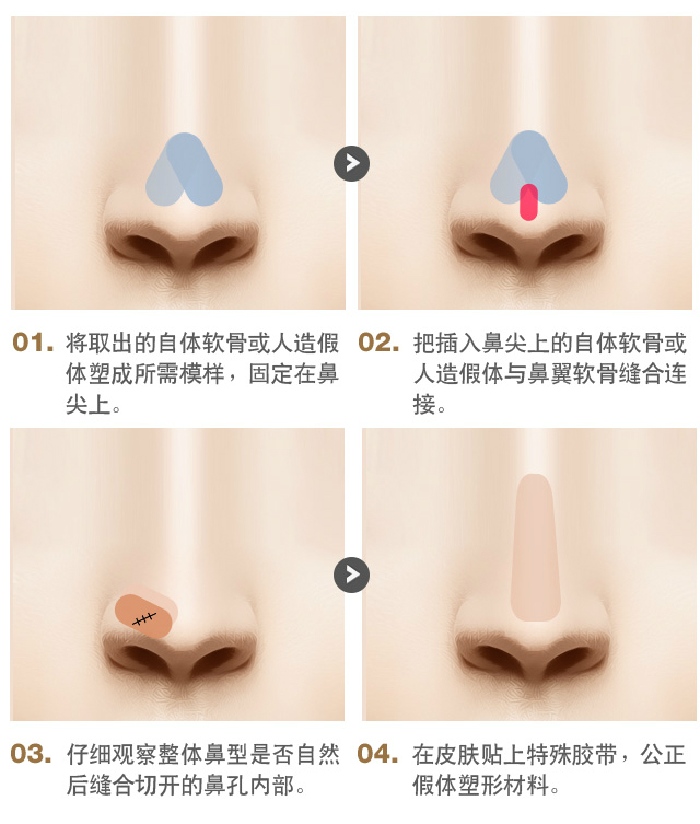 鼻尖整形